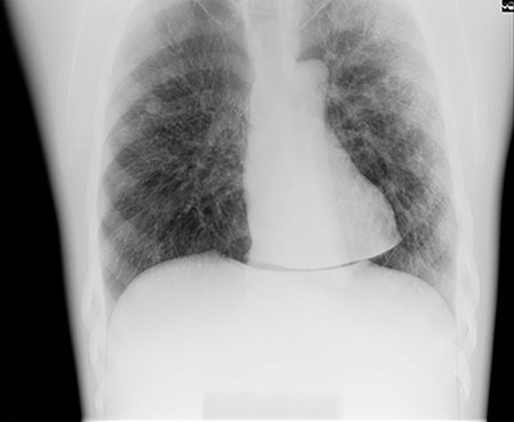 Phantom chest X-ray image